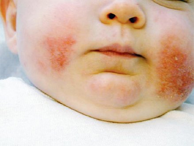 الإكزيما تنقل للأطفال الرضع نتيجة عوامل وراثية 