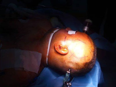 انجاز طبي في المستشفى الجامعي طرابلس بنجاح عملية إزالة ورم خبيث في الرأس 