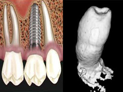 انتاج اسنان جديدة من خلايا اللثة